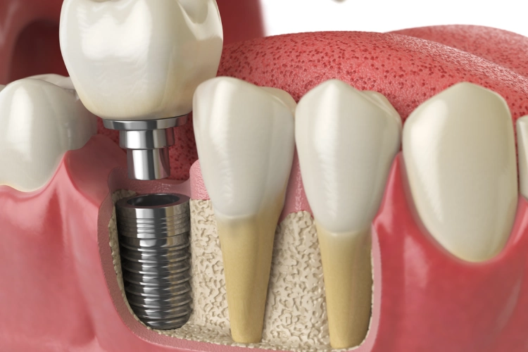 Dental implant restoration completed by New Beam Dental in Port Coquitlam