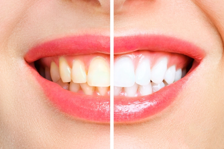 Professional teeth whitening treatment performed at New Beam Dental in Port Coquitlam