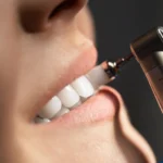 Dental hygienist performing a professional dental cleaning on a patient at New Beam Dental in Port Coquitlam