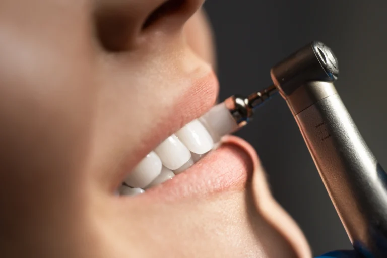 Dental hygienist performing a professional dental cleaning on a patient at New Beam Dental in Port Coquitlam